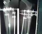 рентген перед снятием аппаратов